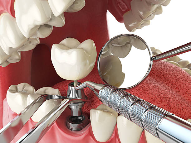 Best Dental Abscess Treatment in Franklin, TX